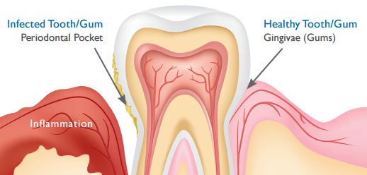 Periodontal Gum Image